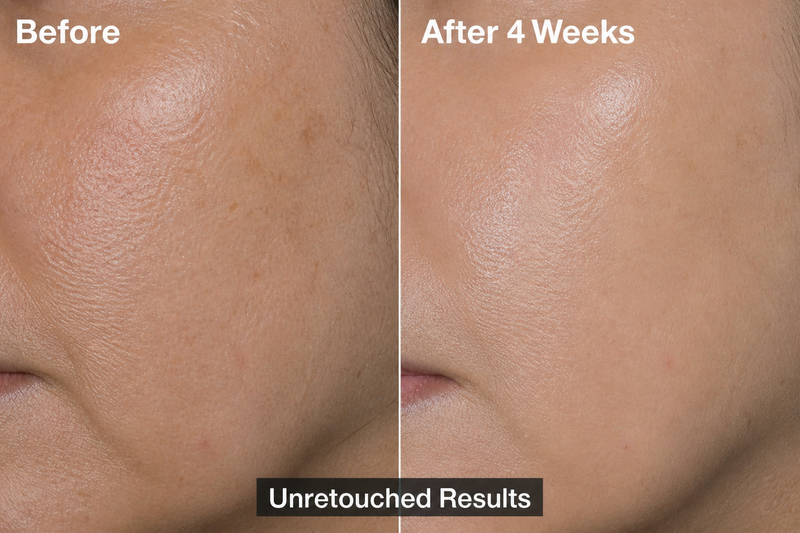 Cheek Texture — After 4 Weeks